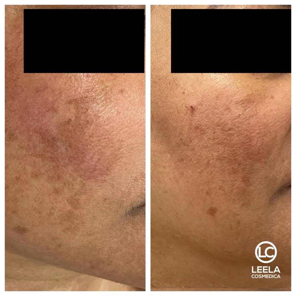leela cosmedica melasma treatment nctf pigmentation rosacea skin brightening beauty skin clinic templestowe