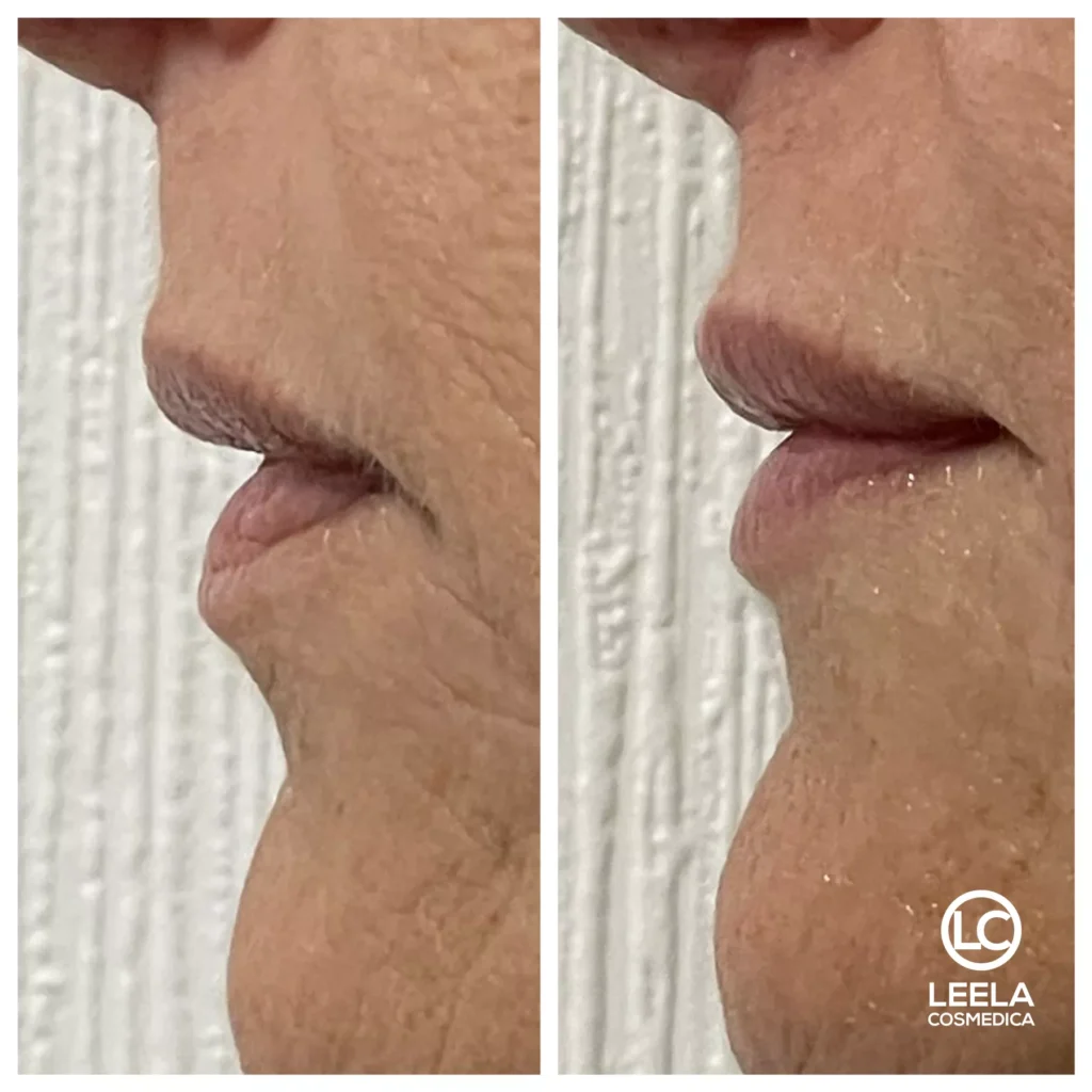 lip dermal filler 3 enhancement rejuvenation skin hydration leela cosmedica