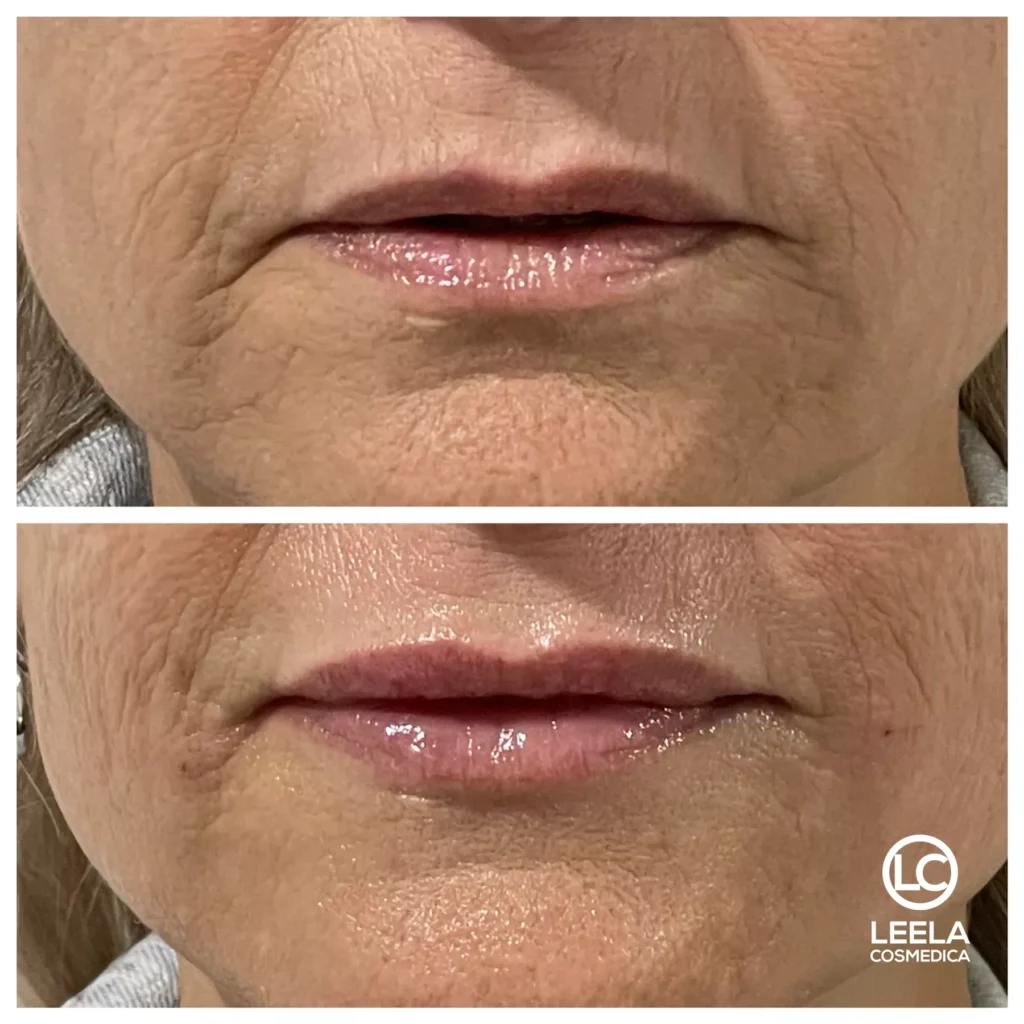 lip dermal filler enhancement rejuvenation skin hydration leela cosmedica