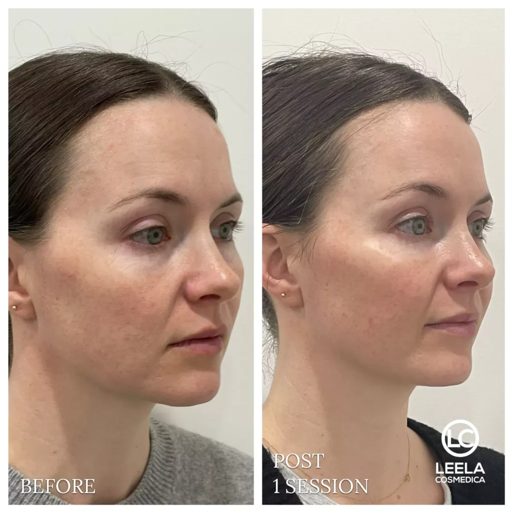 new consult 2