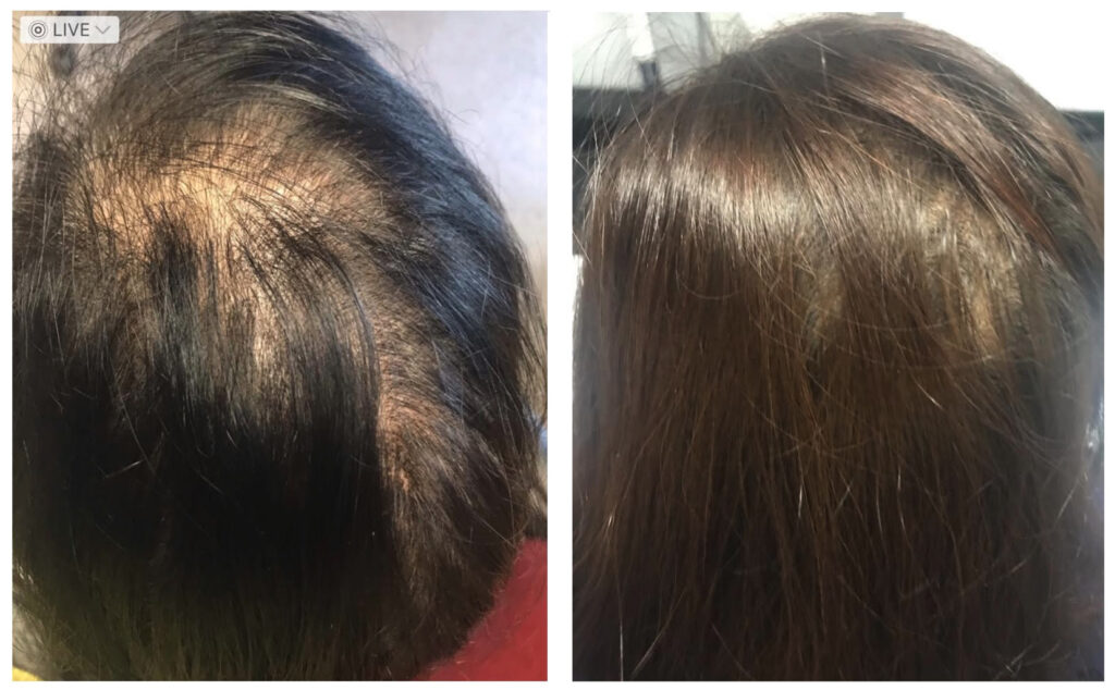 before and after emcyte prp 1