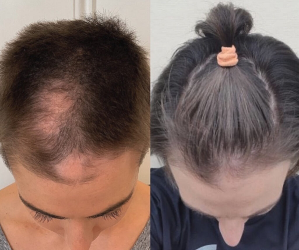 before and after emcyte prp 2