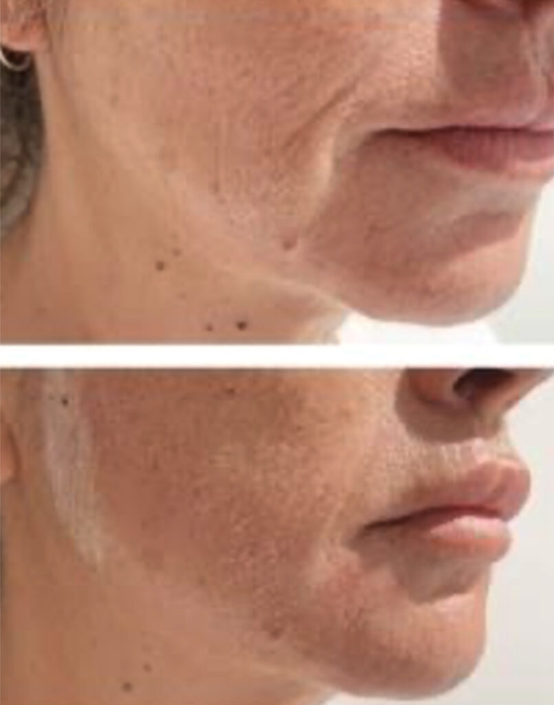 before and after emcyte prp 3