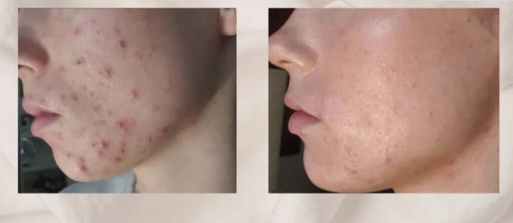 before and after emcyte prp 4