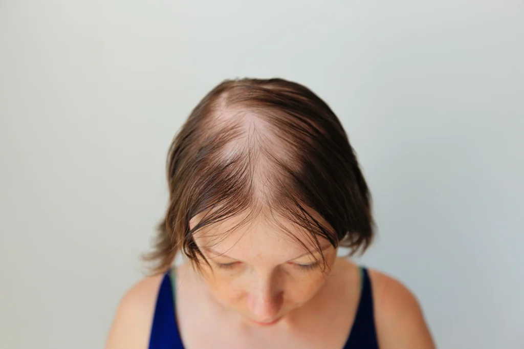 emcyte prp hair loss treatment