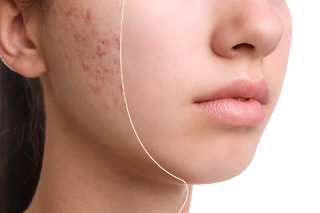 emcyte prp treatment acne scarring